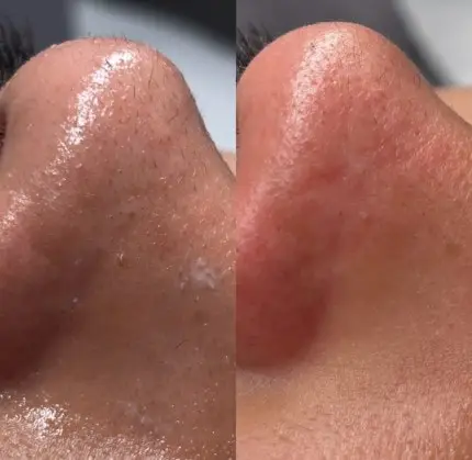 Acne Scar Removal Pleasant View Utah — Ogden Lash and Wax, Ogden UT