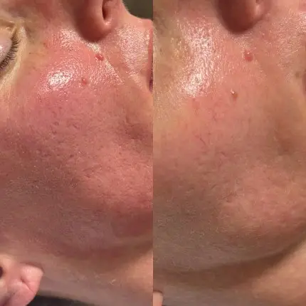 Acne Scar Treatment Pleasant View Ut — Ogden Lash and Wax, Ogden UT