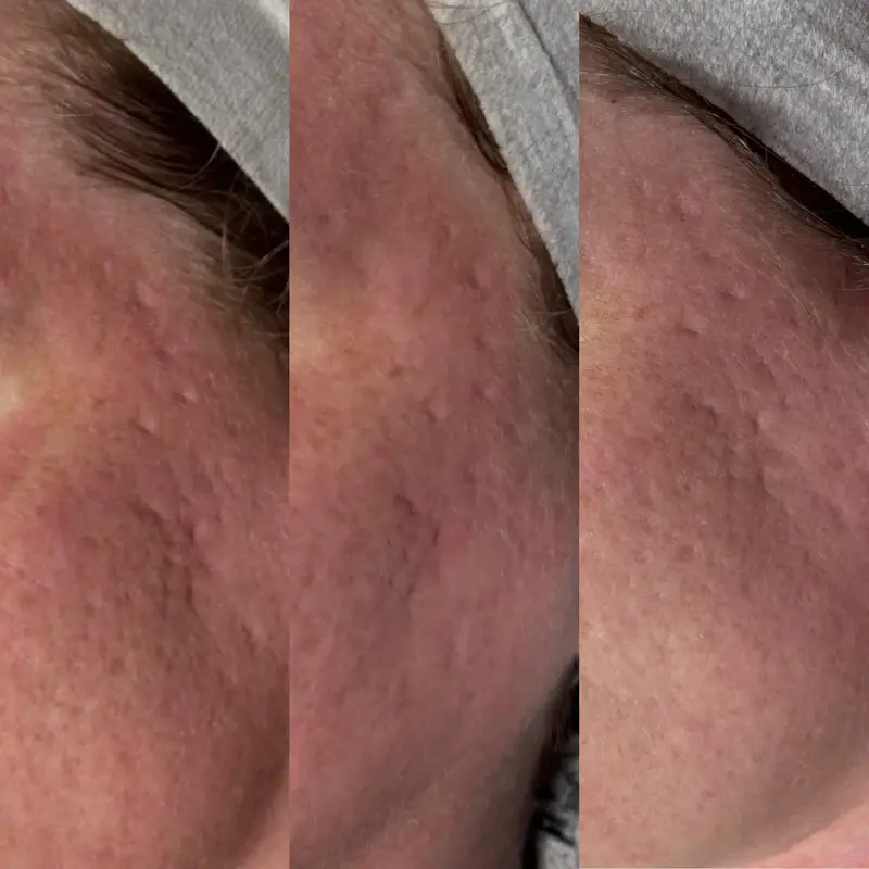 Microneedling Pv — Ogden Lash and Wax, Ogden UT